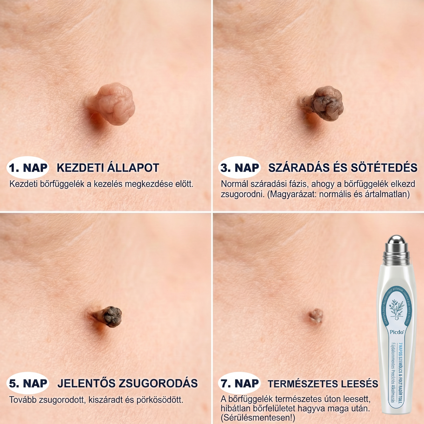 ✅🌱𝐇𝐢𝐯𝐚𝐭𝐚𝐥𝐨𝐬 𝐦á𝐫𝐤𝐚𝐛𝐨𝐥𝐭  𝐏𝐢𝐜𝐝𝐨®   𝟕 𝐍𝐚𝐩𝐨𝐬 𝐁ő𝐫𝐤𝐢𝐧ö𝐯é𝐬- é𝐬 𝐅𝐨𝐥𝐭𝐫𝐚𝐝í𝐫(Fájdalommentes, nyommentes roll-on)